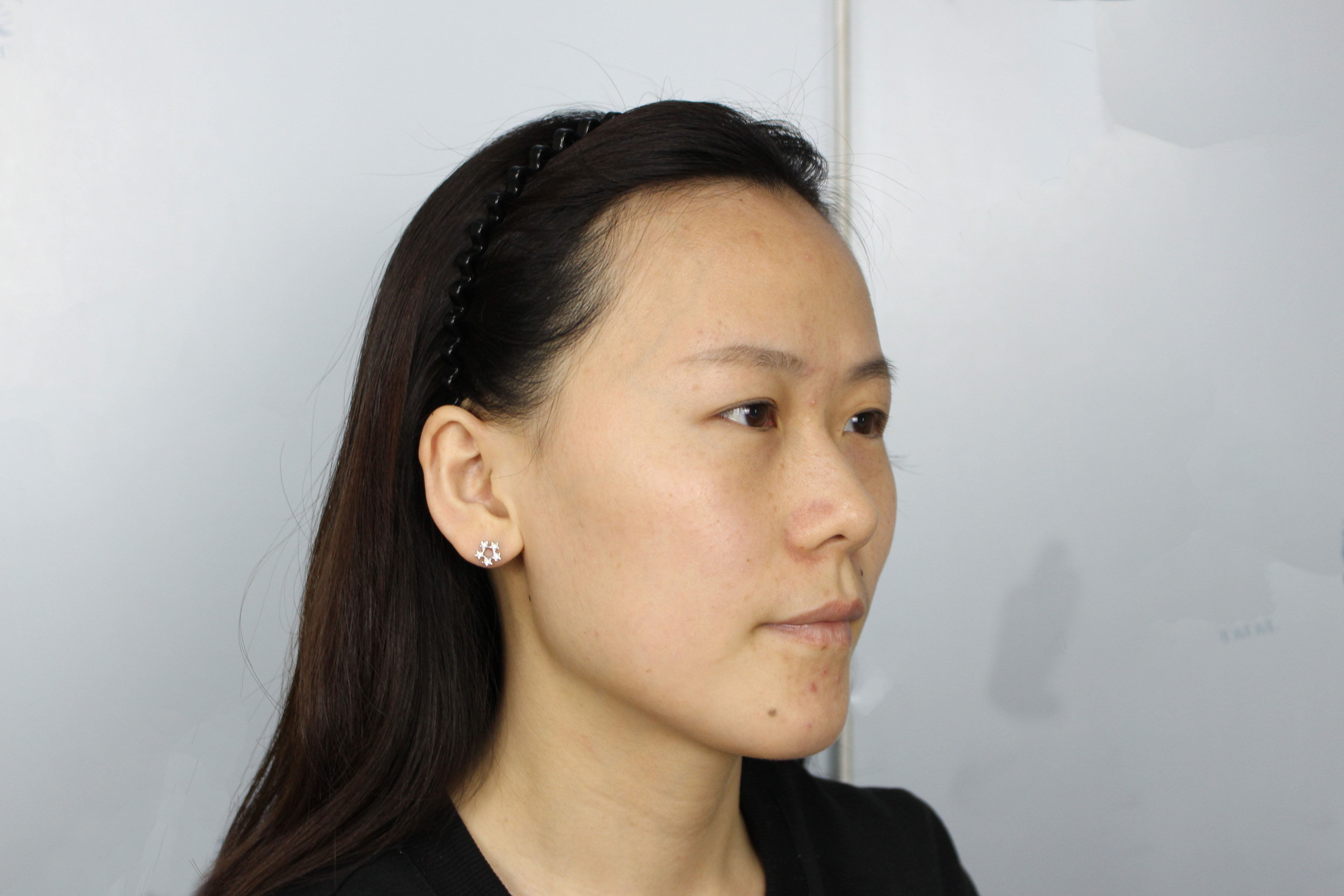 去皱纹多少钱?前后对比图