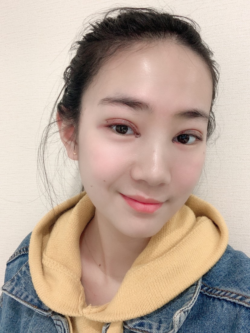 九院谢峰做双眼皮好吗？附双眼皮案例