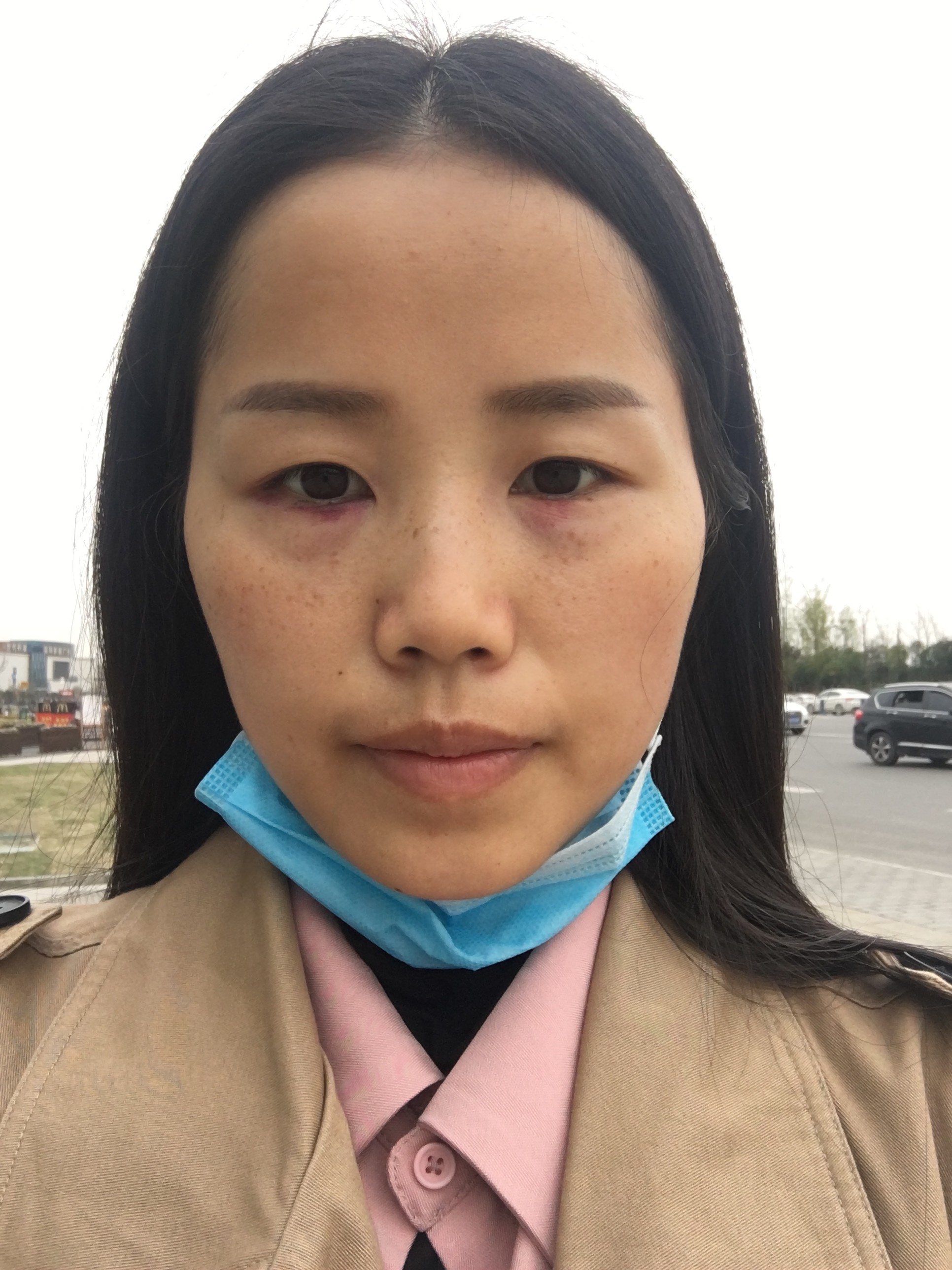 眶隔释放祛眼袋案例分享