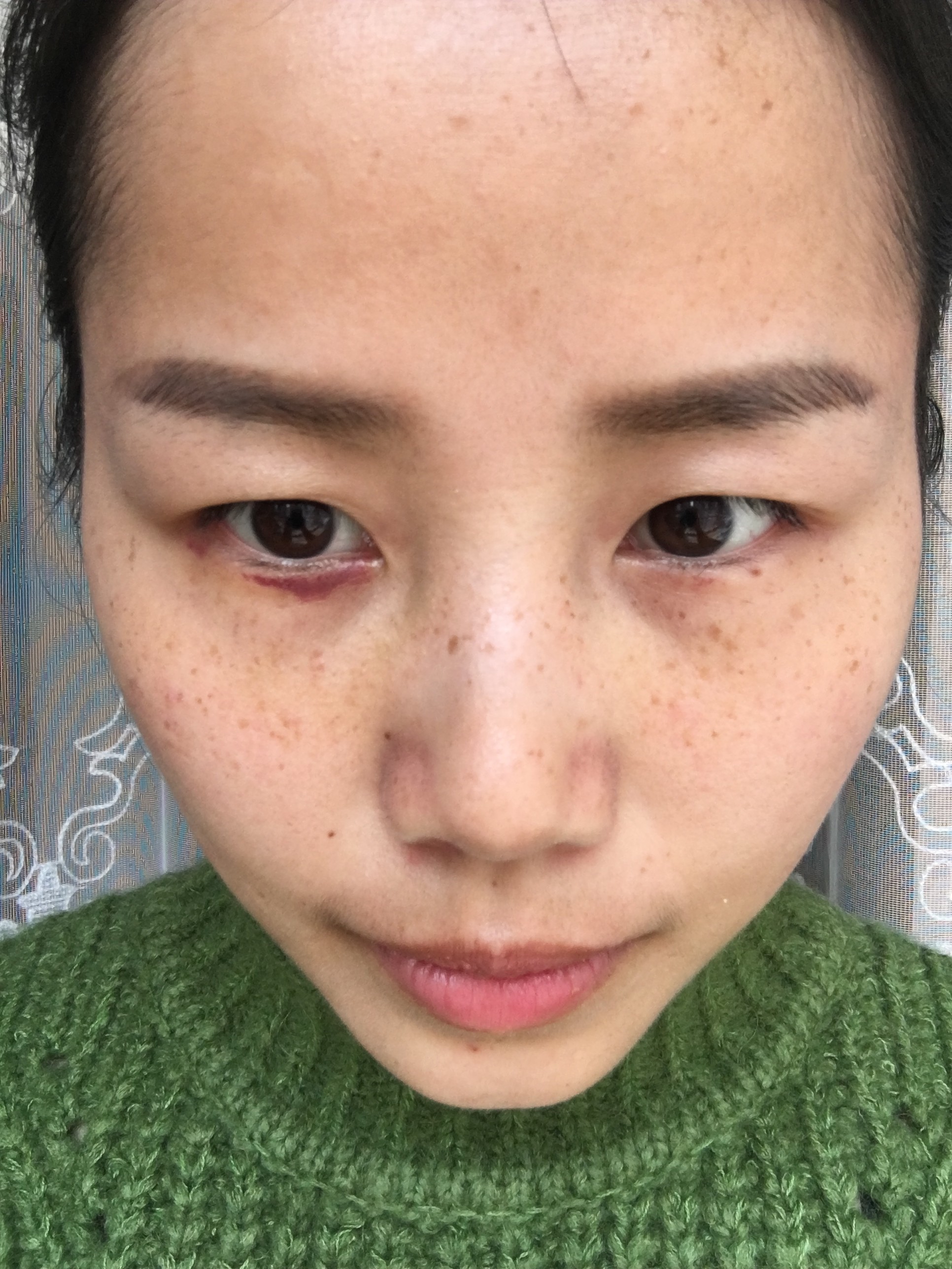 眶隔释放祛眼袋案例分享