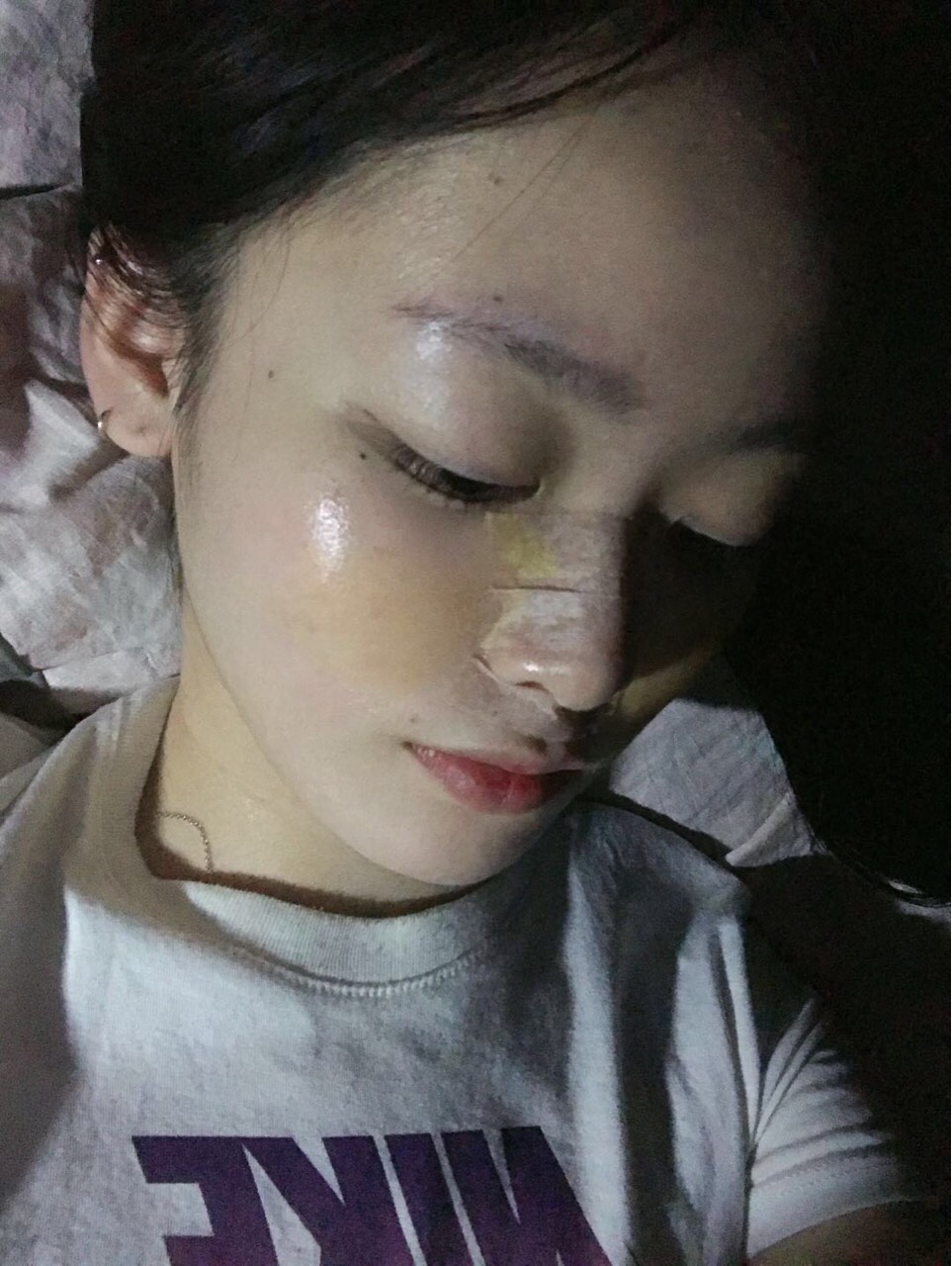 北京米扬丽格巫文云隆鼻案例真人分享