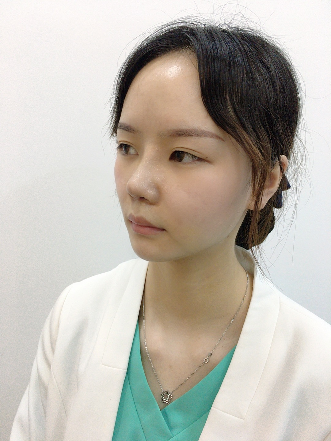 广州曙光整形美容价格表，附鼻部案例