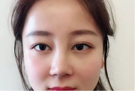 武汉五洲莱美整形美容医院医生刘骏怎么样?附价格表及鼻修复案例