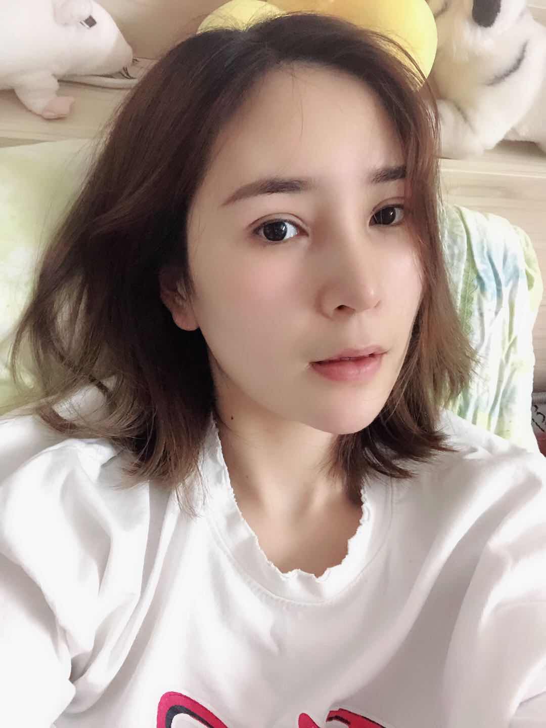 山西武警总医院整形美容科价格表及双眼皮案例