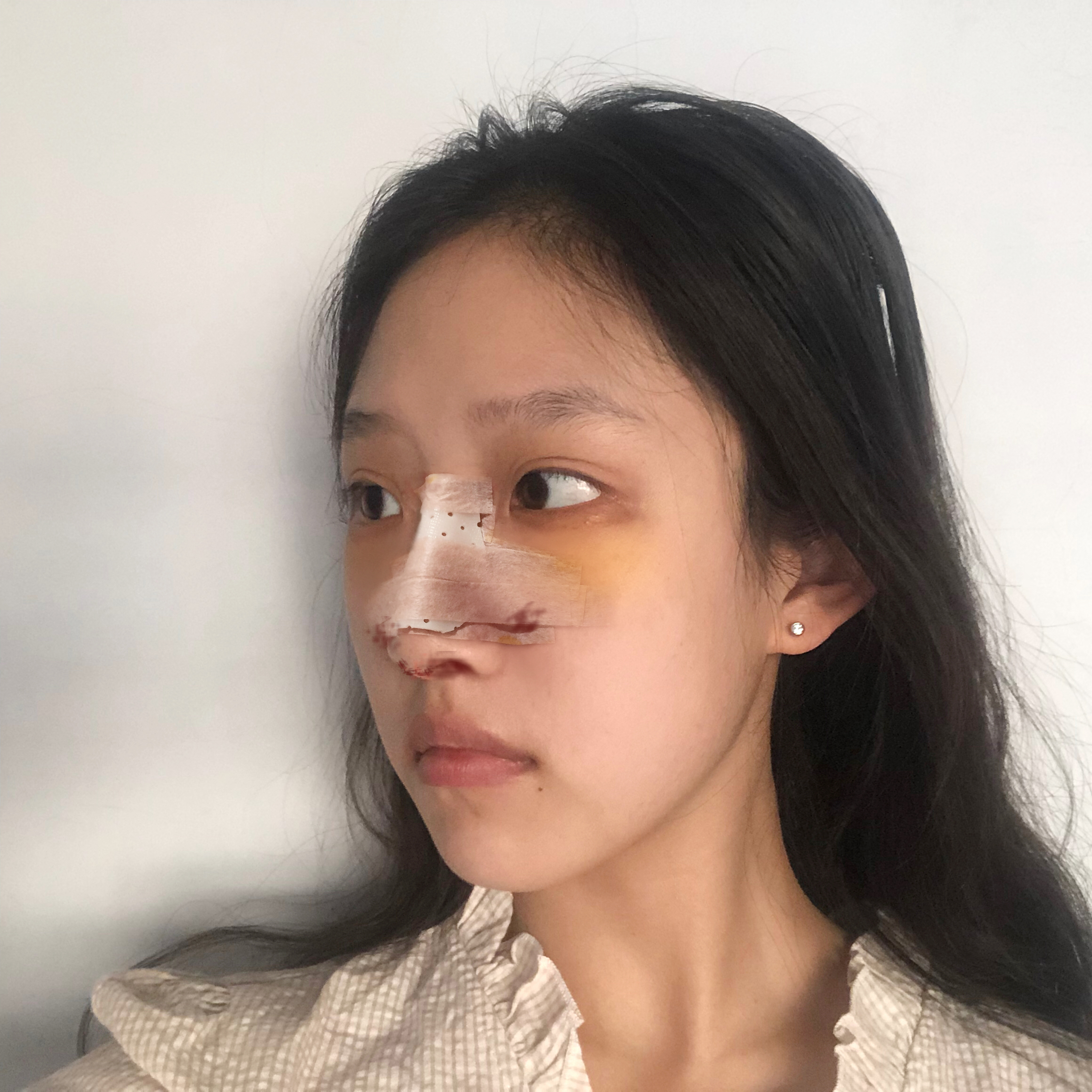 杭州美莱医疗美容医院价格表，附隆鼻案例