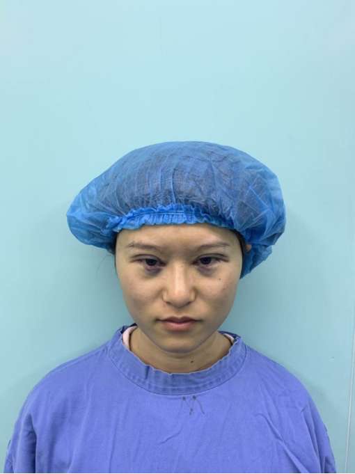 新疆整形美容医院价格表,附全切双眼皮案例