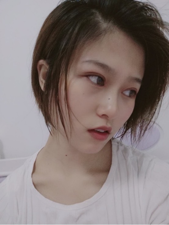 新疆整形美容医院价格表,附切开双眼皮案例
