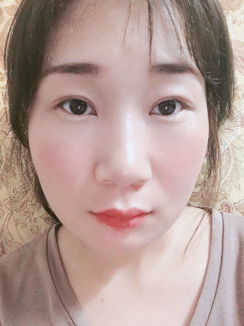 广州越秀紫馨曹仁昌双眼皮修复怎么样?附双眼皮修复案例