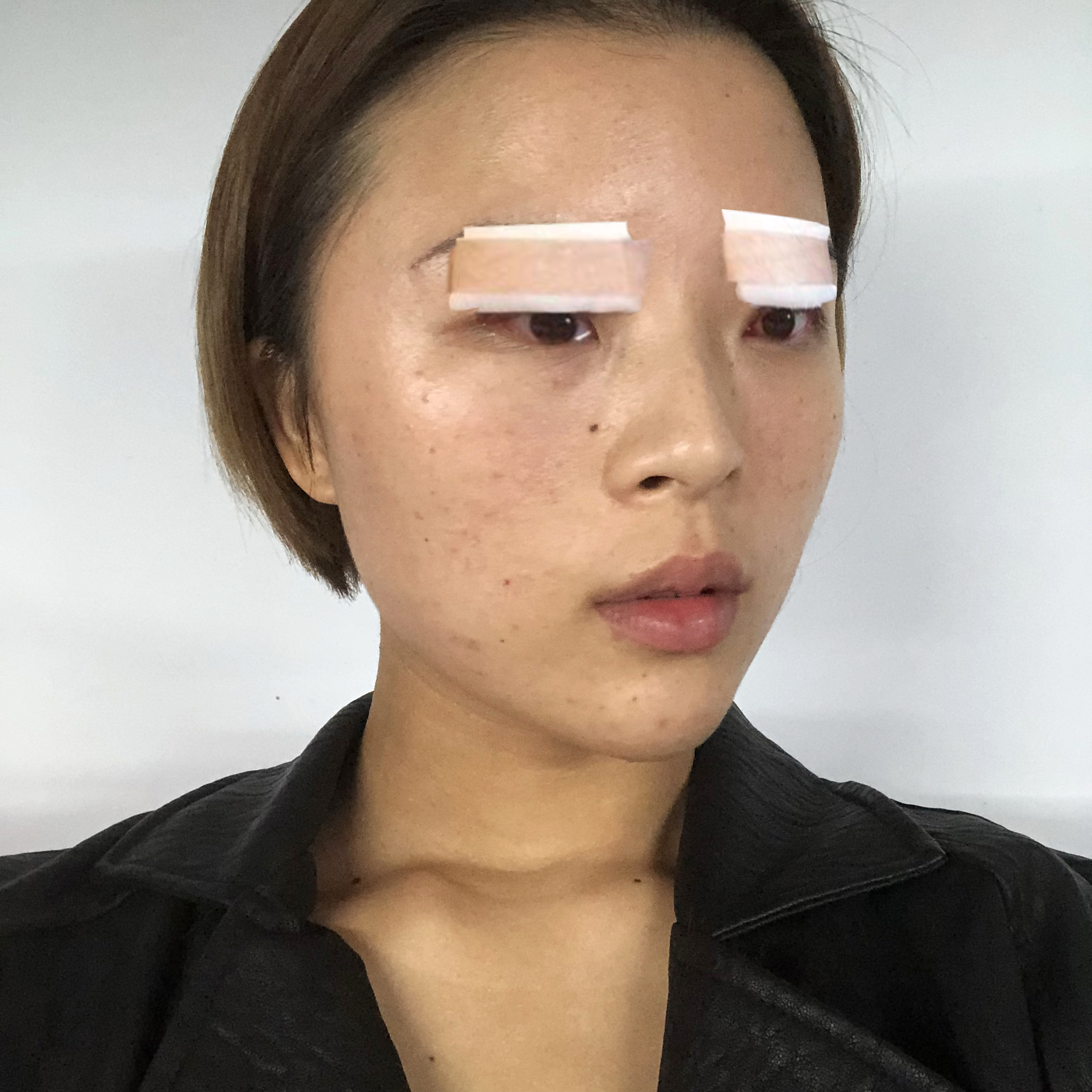 郑州爱美丽整形美容崔黎丹做双眼皮怎么样，附双眼皮案例及价格表