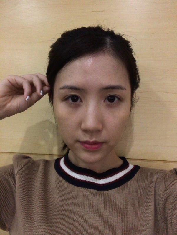 中山爱思特整形医院价格表，附自体脂肪面部填充
