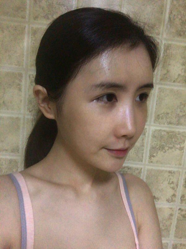 中山爱思特整形医院价格表，附自体脂肪面部填充案例