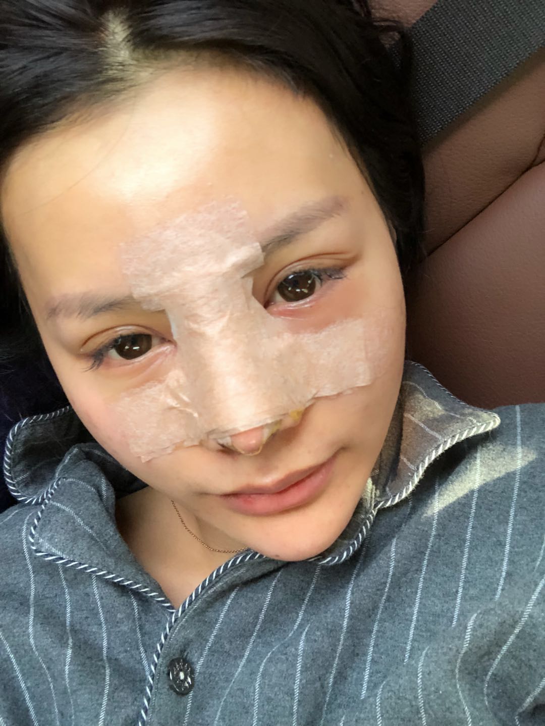 大连康桥整形医院价格表，附假体隆鼻案例