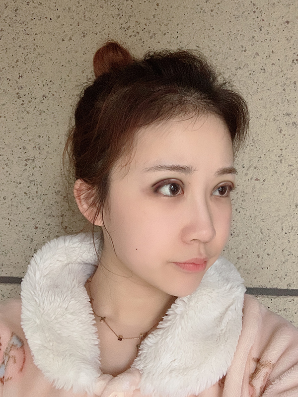 成都圣丹福整形美容医院2020年价格表，附双眼皮案例