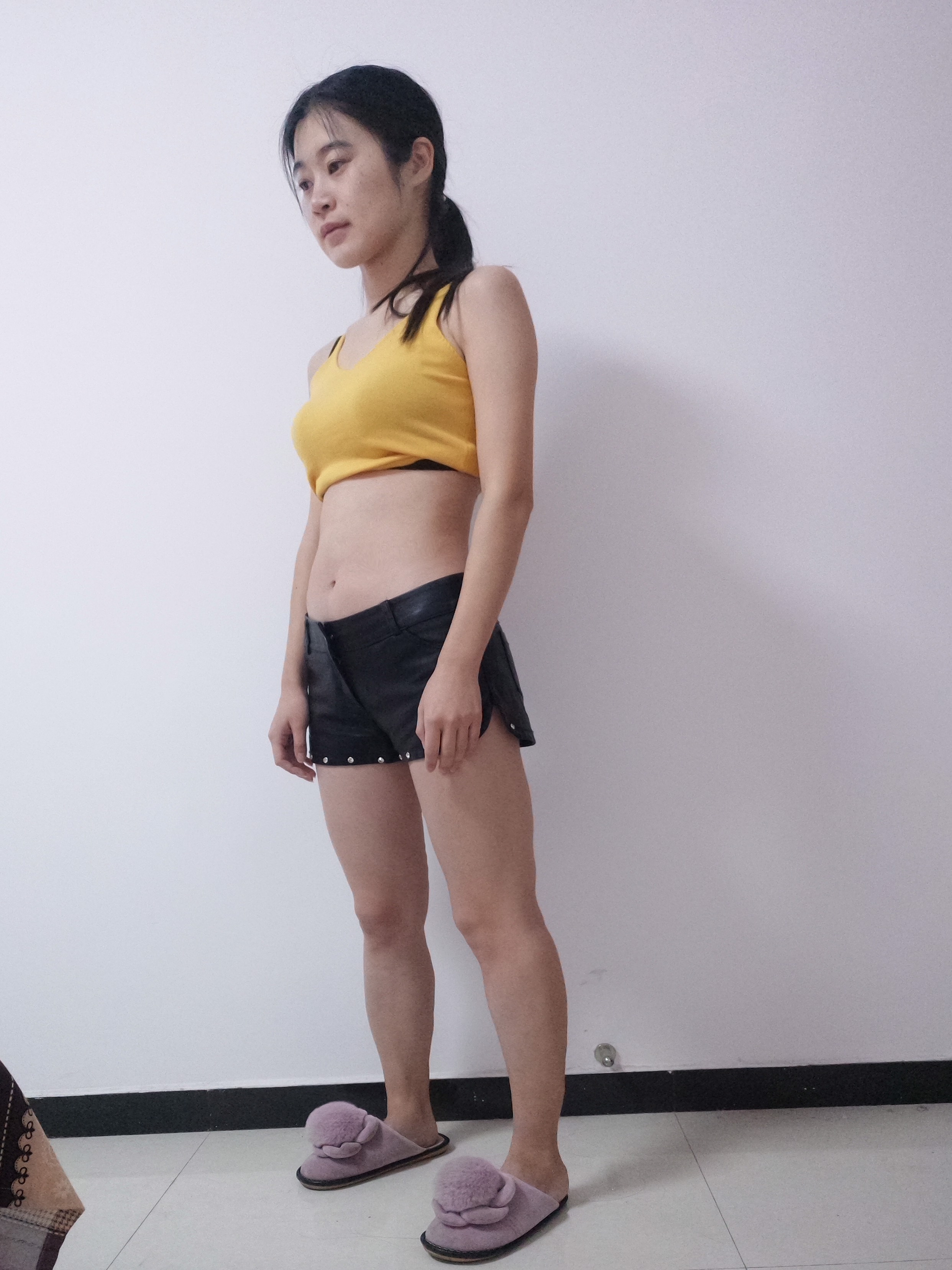 重庆珂琳雅整形美容王陈做吸脂手术怎么样？附吸脂瘦腿案例及价格表