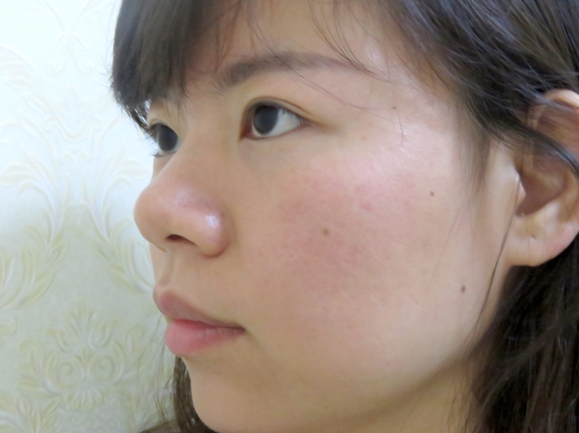 武汉美立方医疗美容胡江伟做鼻子手术怎么样？附隆鼻案例