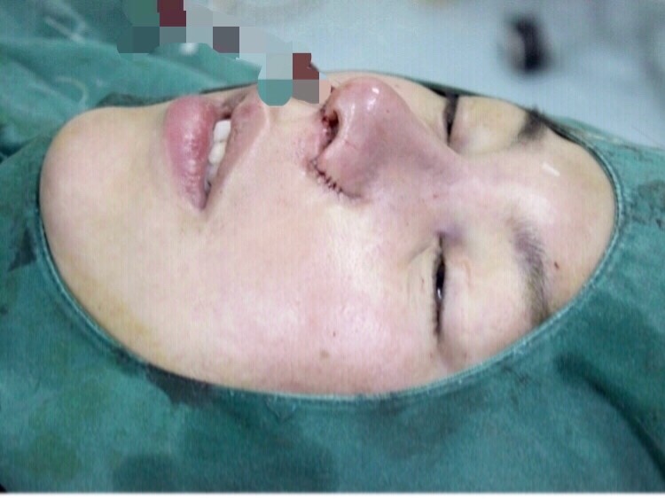 武汉美立方医美美容整形医院胡江伟做鼻子手术怎么样？附隆鼻真人案例