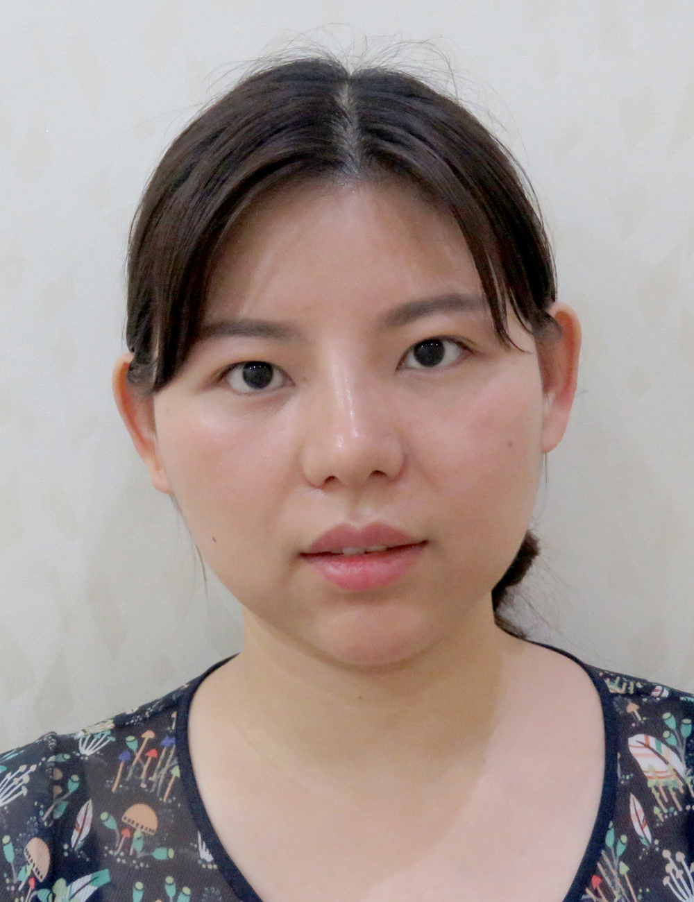 武汉美立方医疗美容整形医院胡江伟做鼻子手术怎么样？附隆鼻真人案例