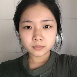 深圳福华医疗美容医院顾伟明做鼻子怎么样？附隆鼻案例恢复图
