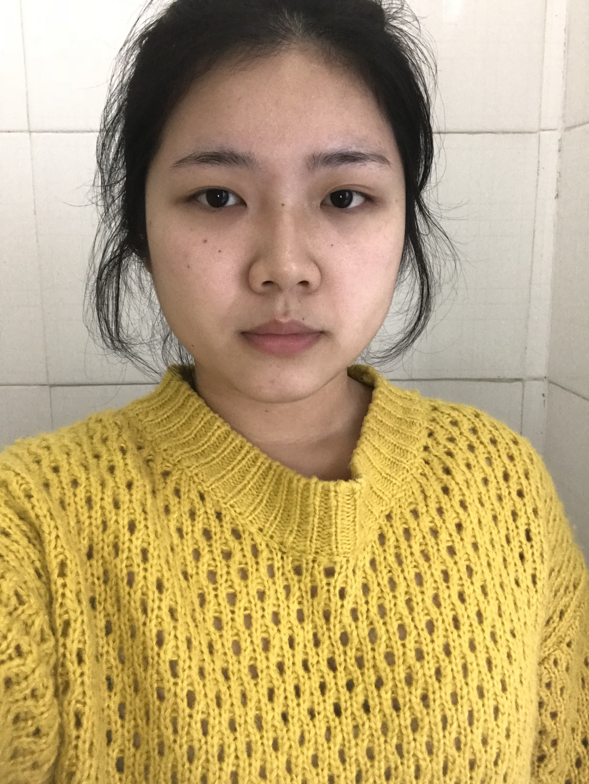 深圳福华医疗美容医院顾伟明做鼻子怎么样？附隆鼻案例恢复图