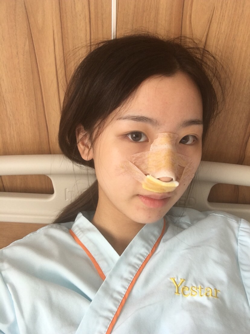 宁波艺星医疗美容医院刘卫做鼻部整形怎么样？附鼻部案例
