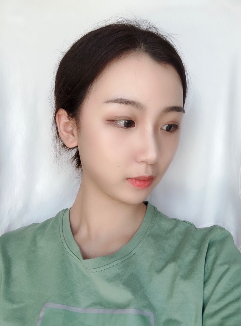 宁波艺星医疗美容医院刘卫做鼻部整形怎么样？附鼻部案例