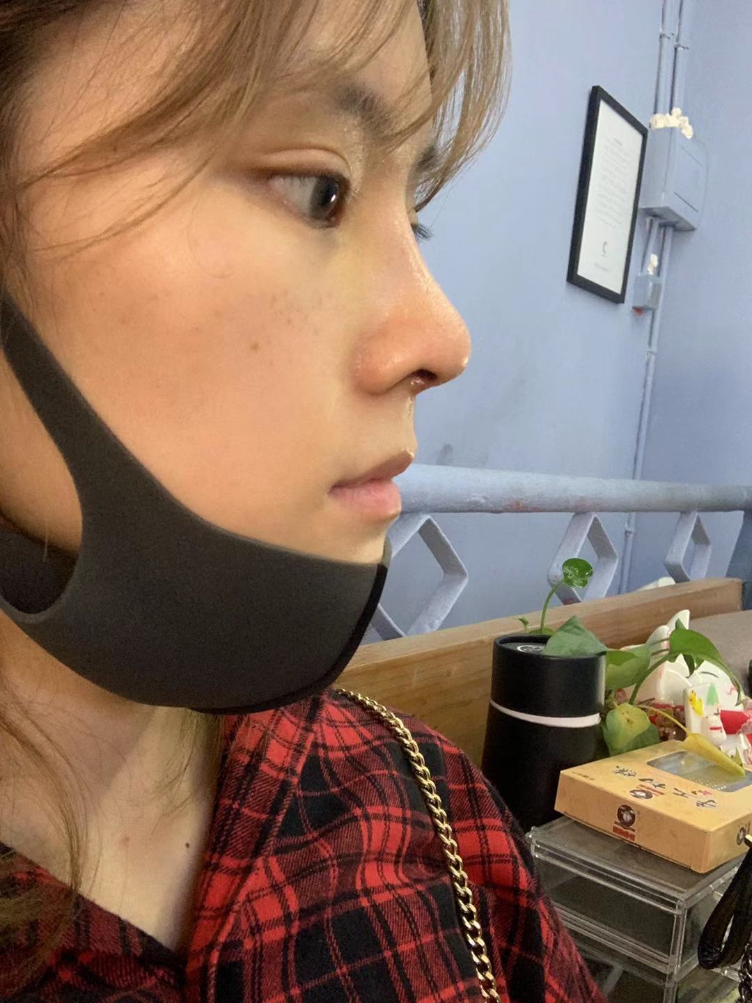 长沙雅美医疗美容医院田芳斌隆鼻好吗？附隆鼻案例