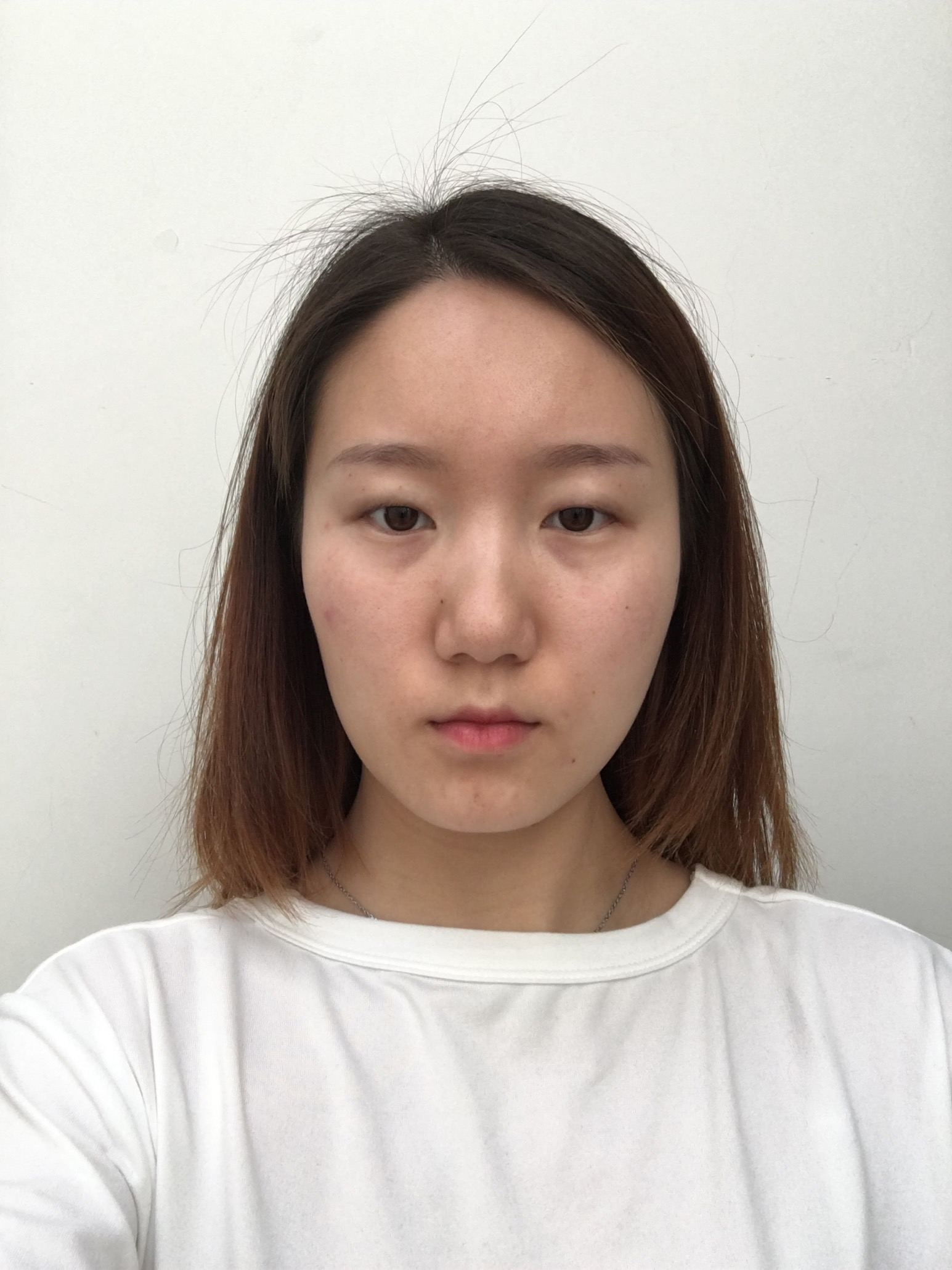黑龙江解放军211医院整形美容中心价格表,附双眼皮案例