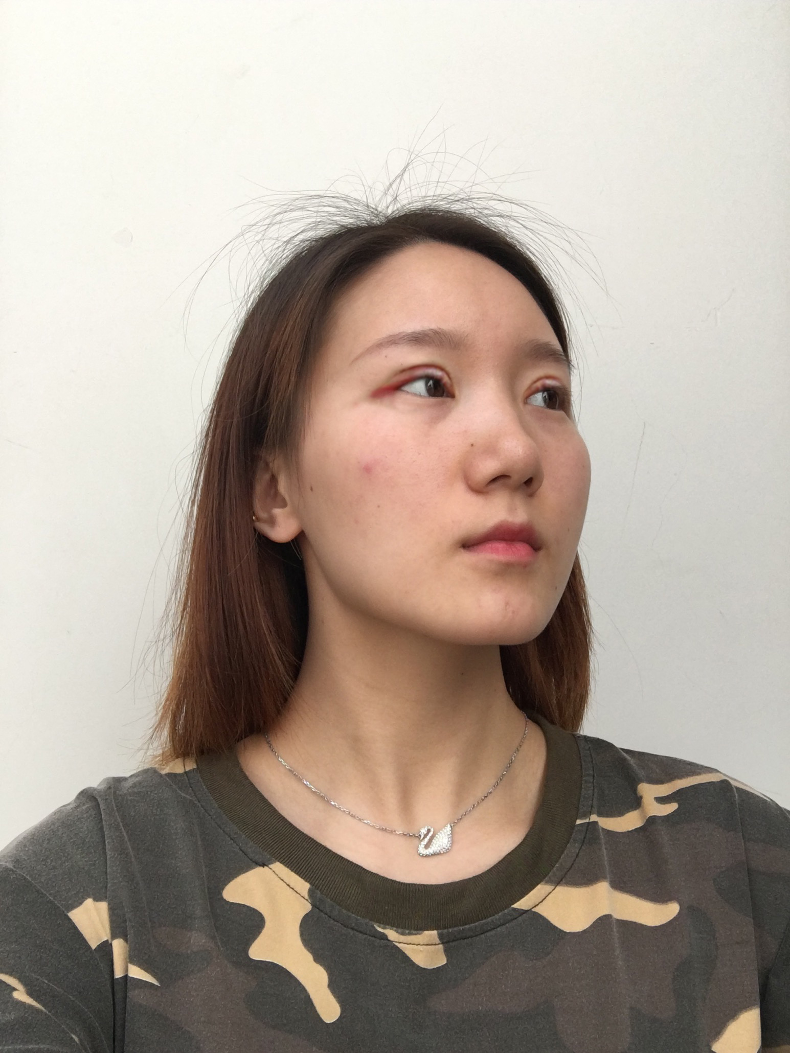 黑龙江解放军211医院整形美容中心价格表，附双眼皮案例