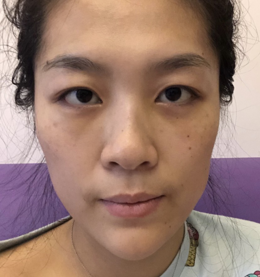 郑州华领医疗美容医院价格表，附祛眼袋案例