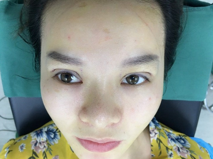 乐山达芬奇医疗美容医院价格表,附双眼皮案例