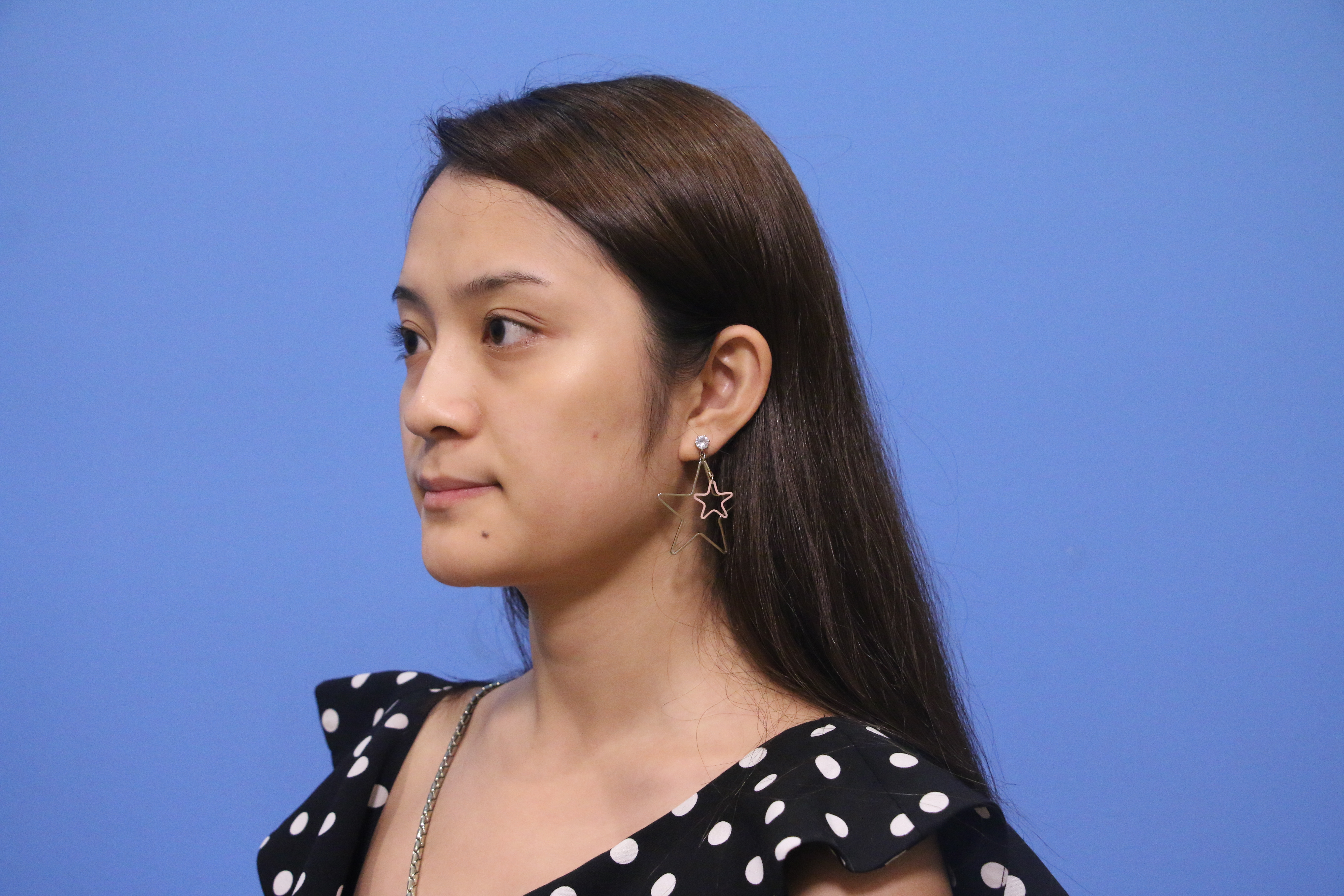 四川娇点医学美容医院姜宇禄做鼻子怎么样？附真人隆鼻恢复图