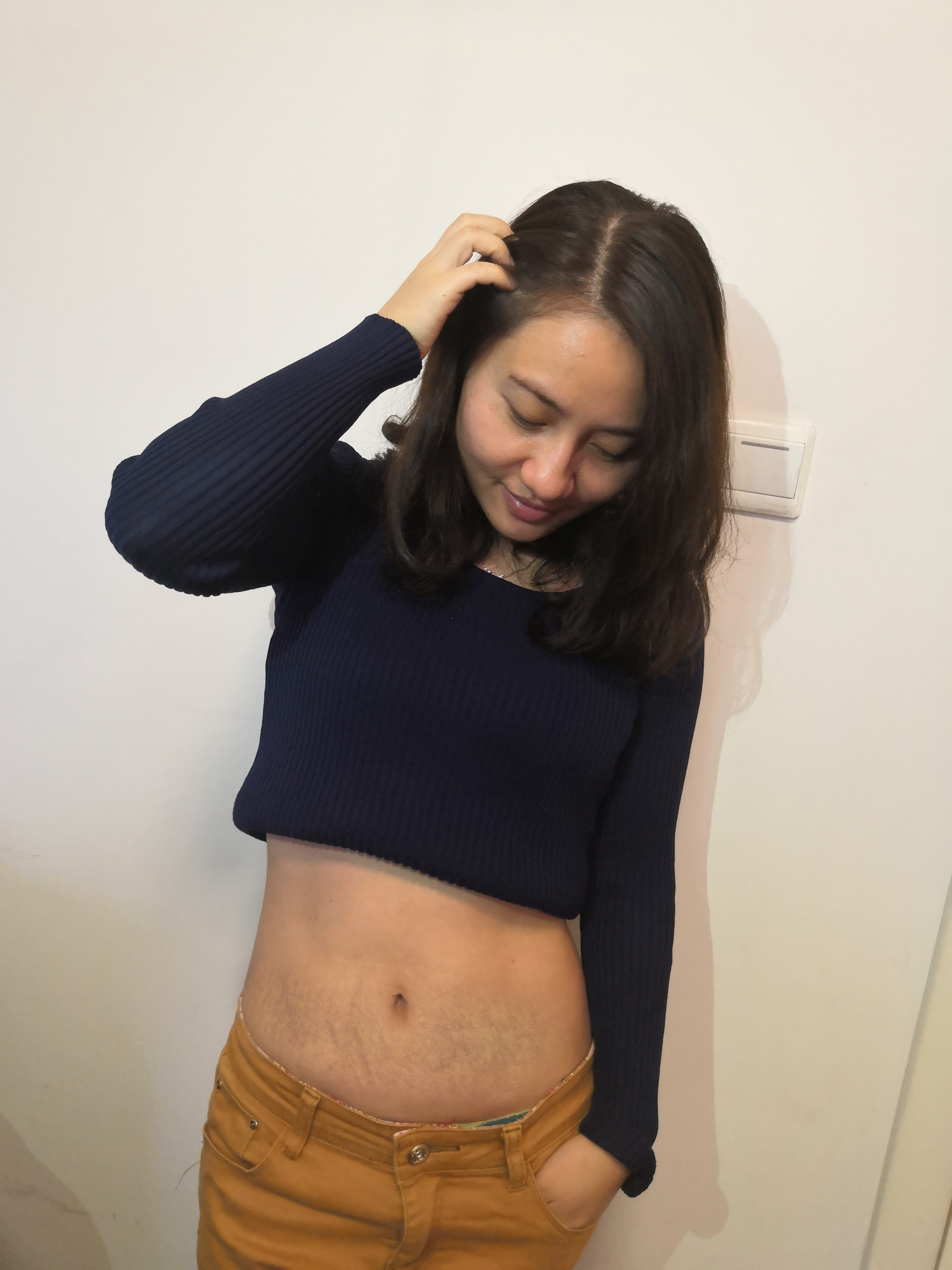 成都恒博皮肤光学美容科价格表，附去妊娠纹案例