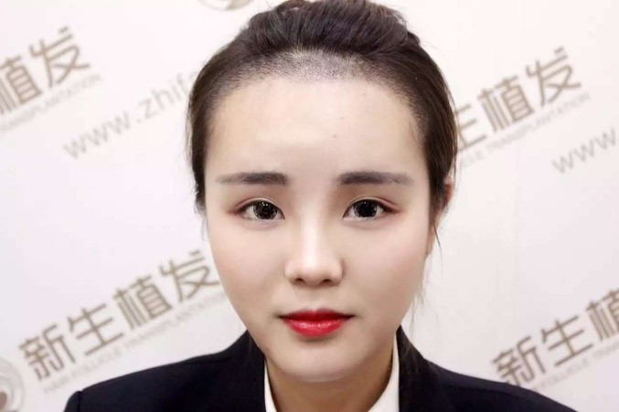 杭州新生植发价格表。附植发案例