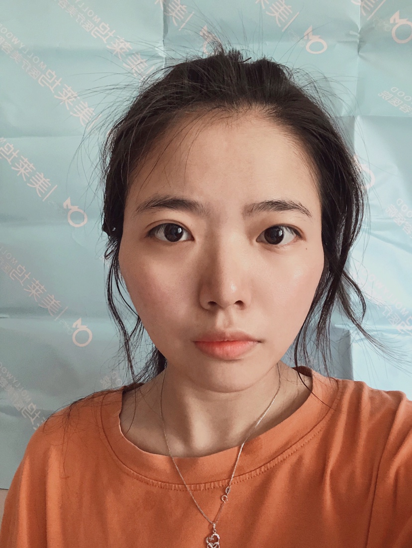 阜阳东方美莱坞医疗美容价格表，附自体脂肪全脸填充案例