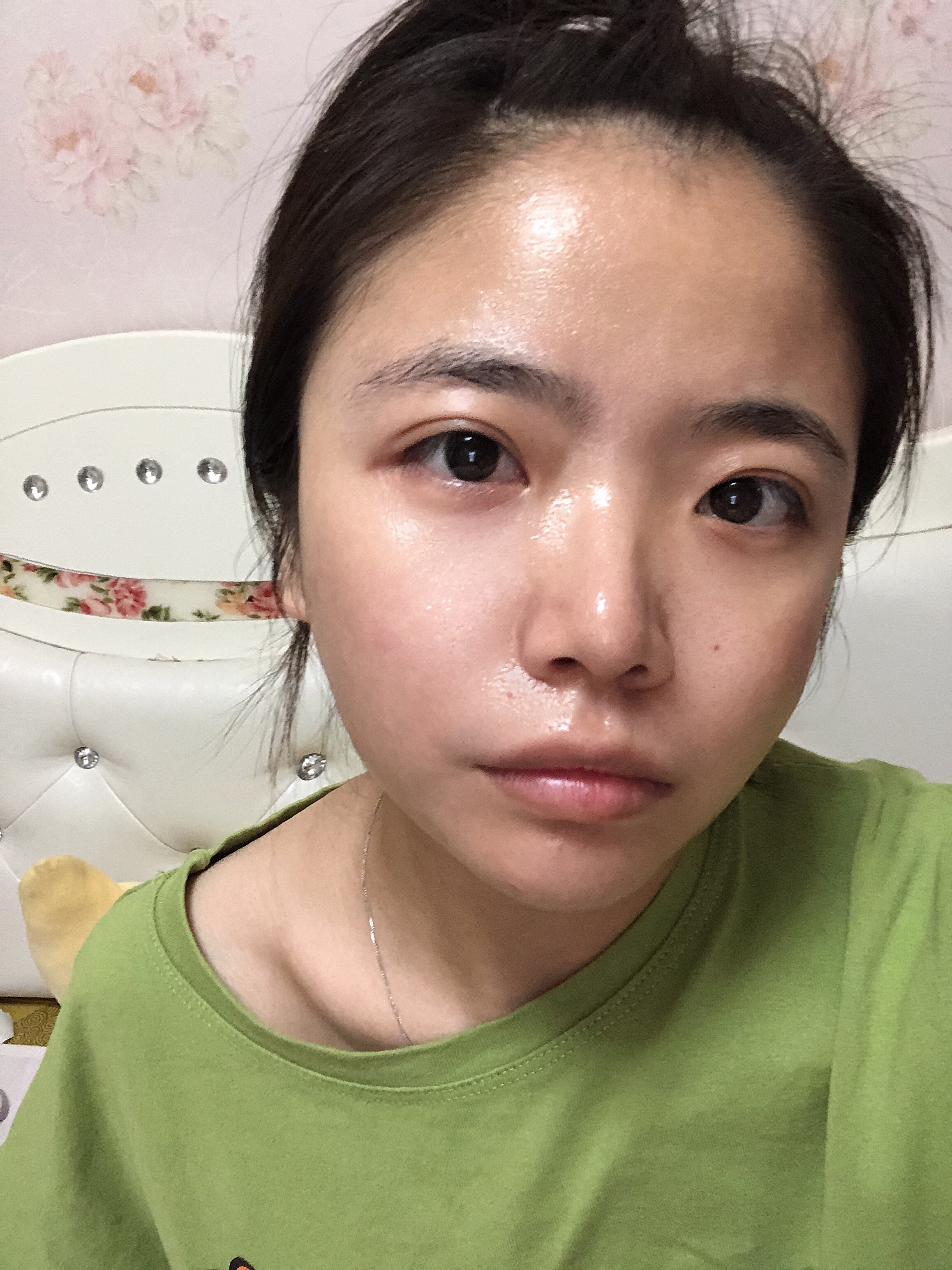 阜阳东方美莱坞医疗美容价格表，附自体脂肪全脸填充案例