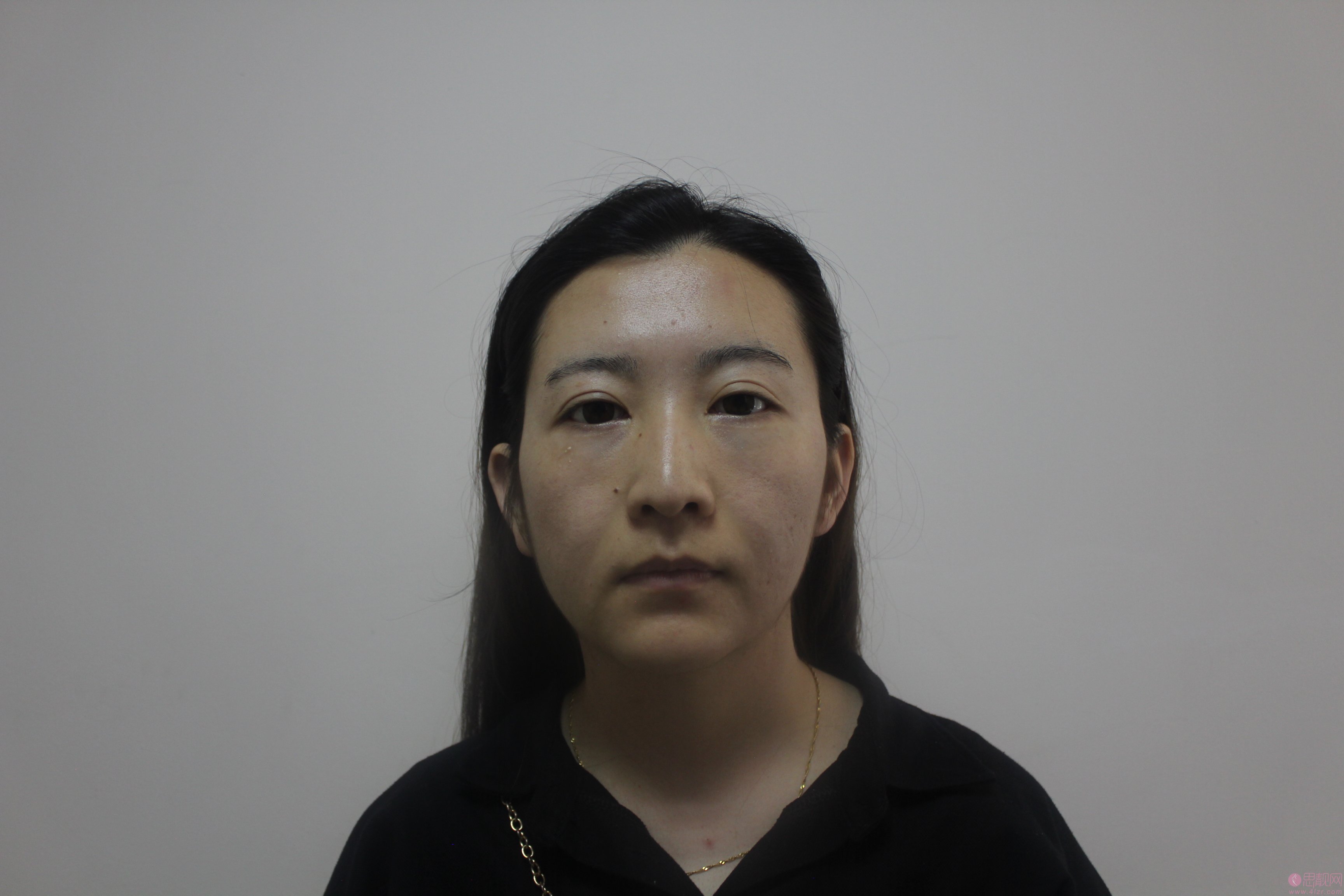 成都西区医院整形毛健清医生脂肪填充怎么样，附价格表