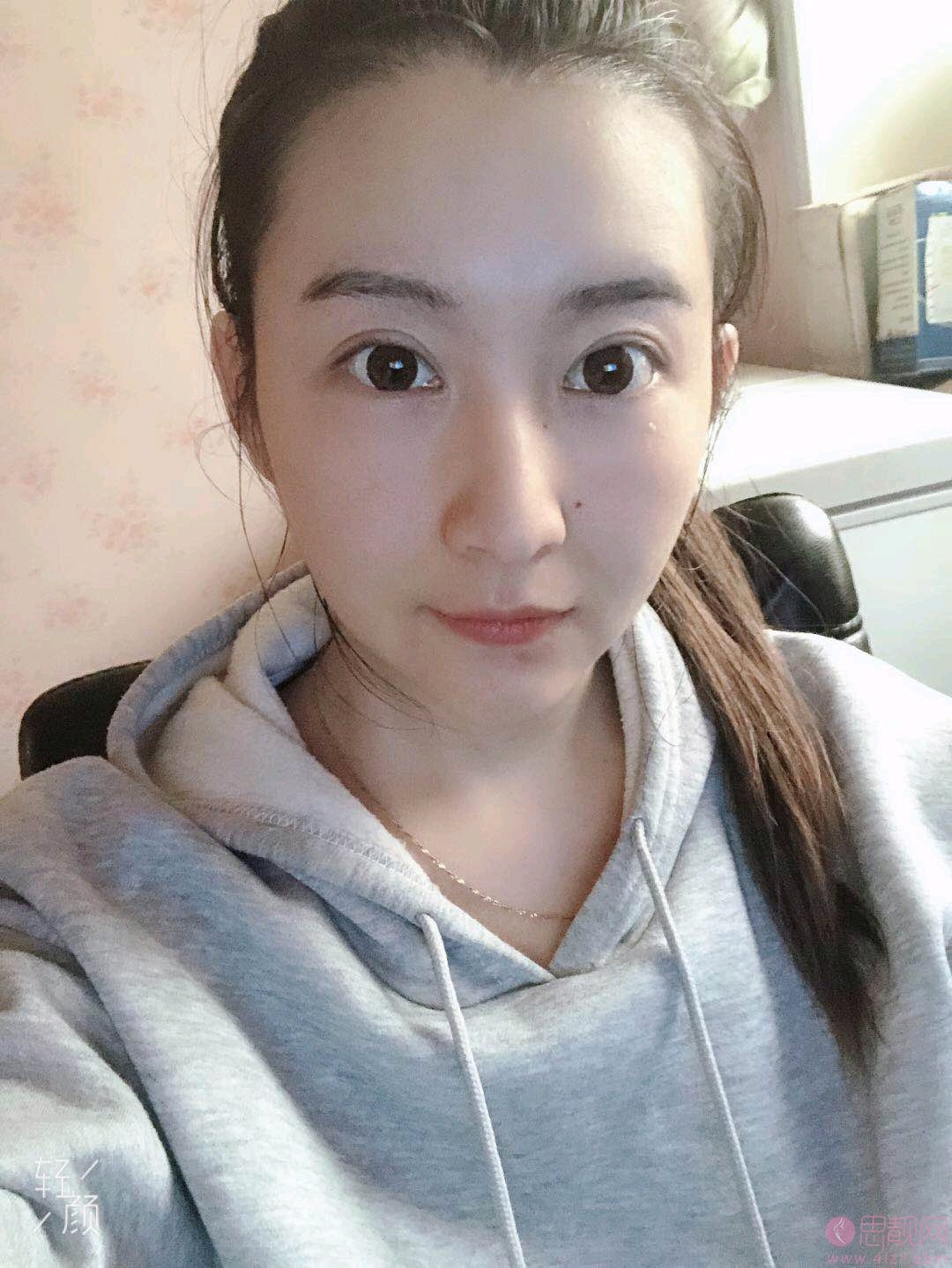 成都西区医院整形毛健清医生脂肪填充怎么样，附价格表