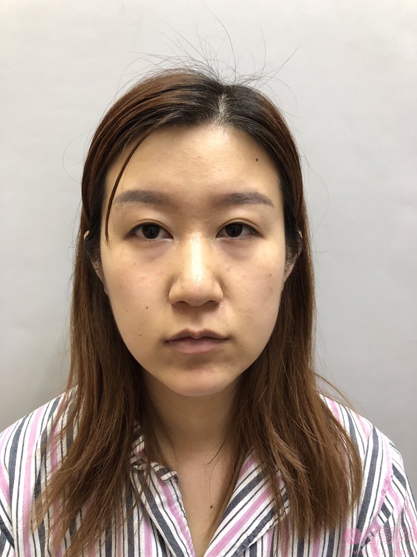 陈庚圣做双眼皮修复怎么样，多少钱