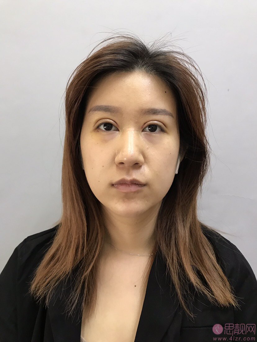 陈庚圣做双眼皮修复怎么样，多少钱