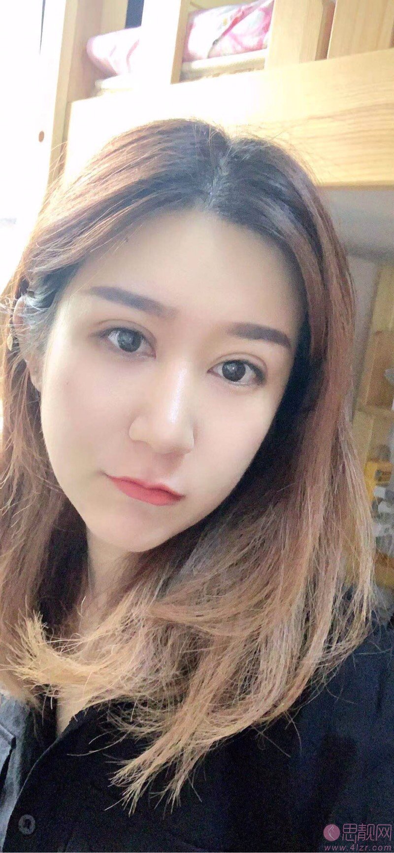 陈庚圣做双眼皮修复怎么样，多少钱