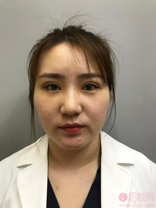北京彤美刘风卓修复双眼皮怎么样，附双眼皮修复真人案例
