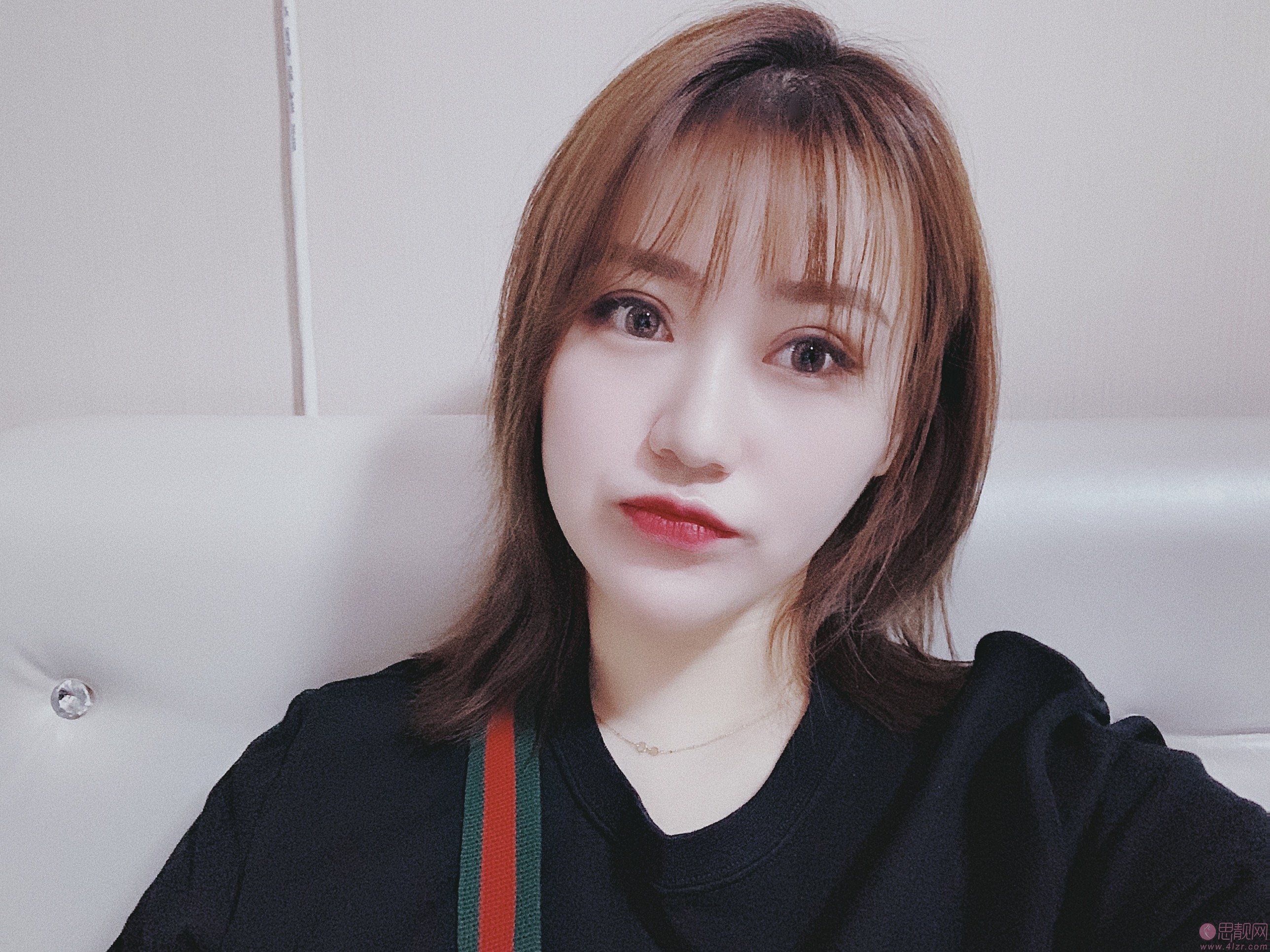 北京彤美刘风卓修复双眼皮怎么样，附双眼皮修复真人案例