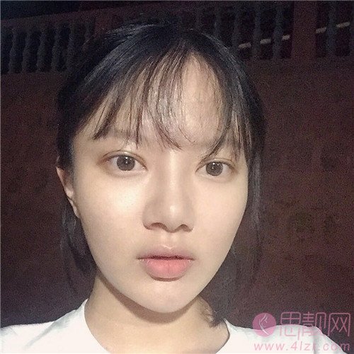 上睑提肌价格