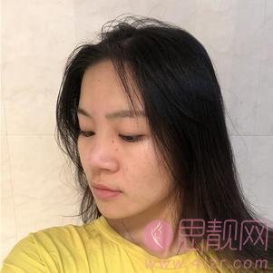 杭州东方整形宋亚芬医生隆鼻案例，附医院价格表