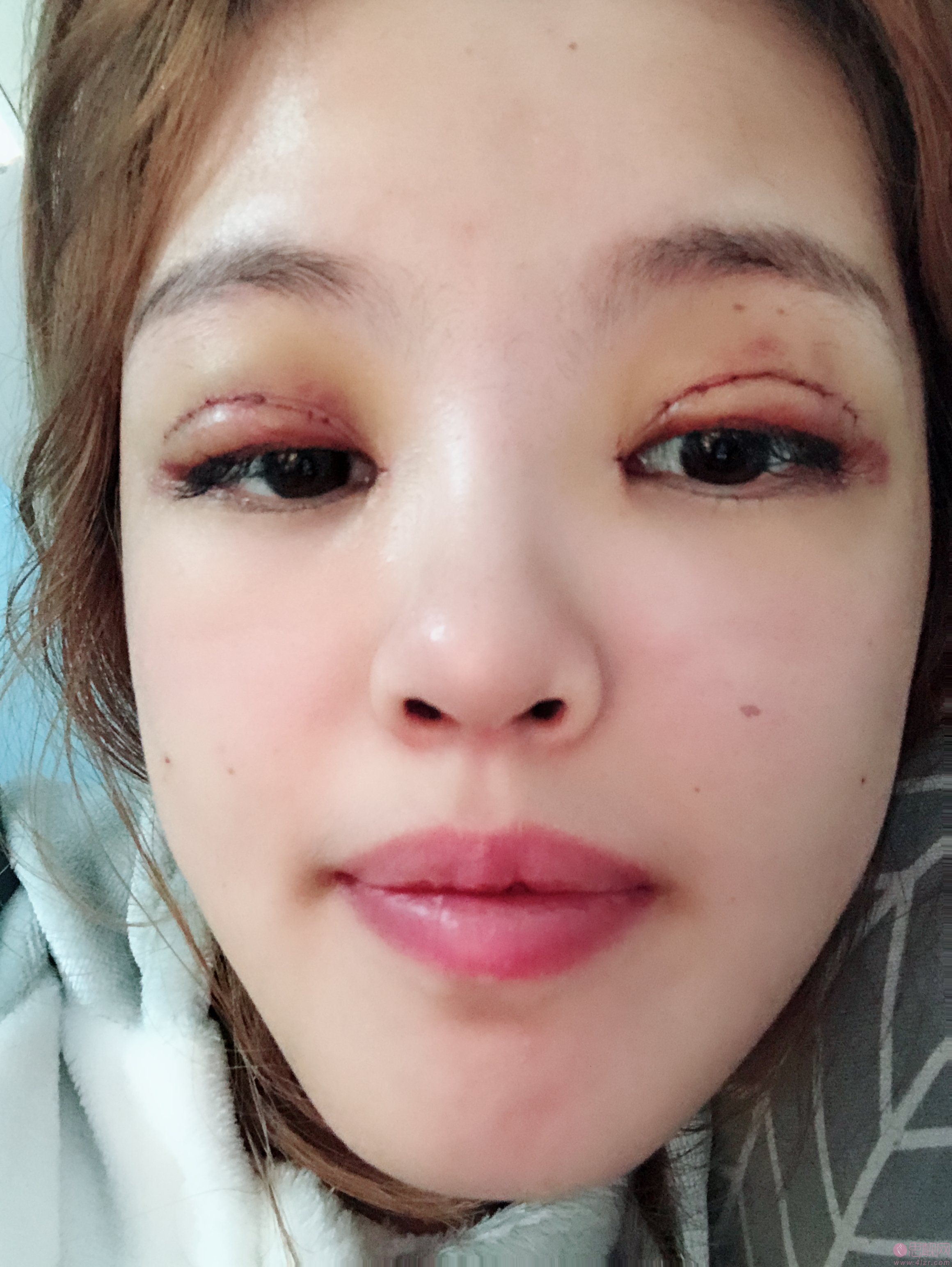 四川华西医院整形科价格表，附肖海涛医生双眼皮案例