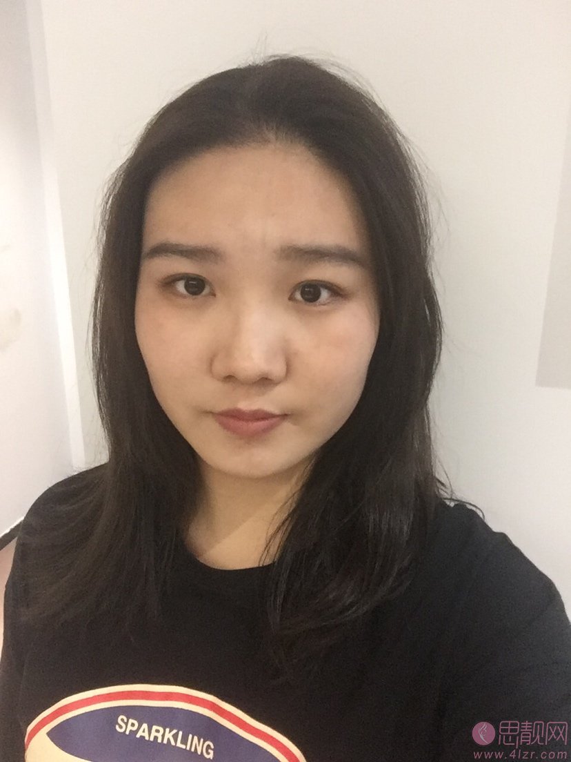 江苏南京施尔美整形美容医院价格表,附面部吸脂案例分享