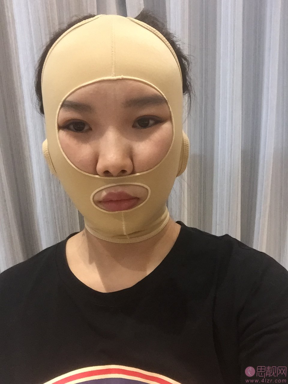江苏南京施尔美整形美容医院价格表,附面部吸脂案例分享