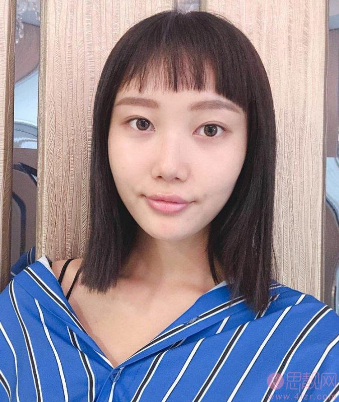 武汉希斯特杨权明做鼻子怎么样？附鼻子案例及价格表