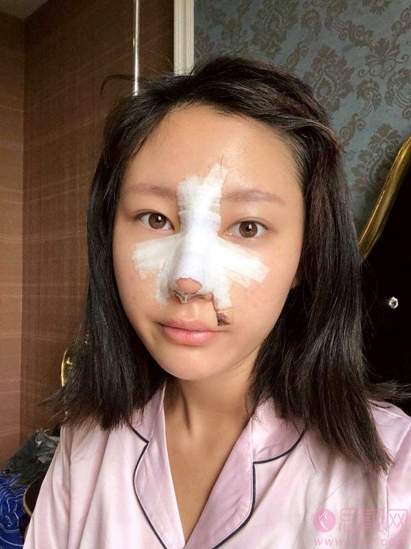 武汉希斯特杨权明做鼻子怎么样，附鼻子案例及价格表