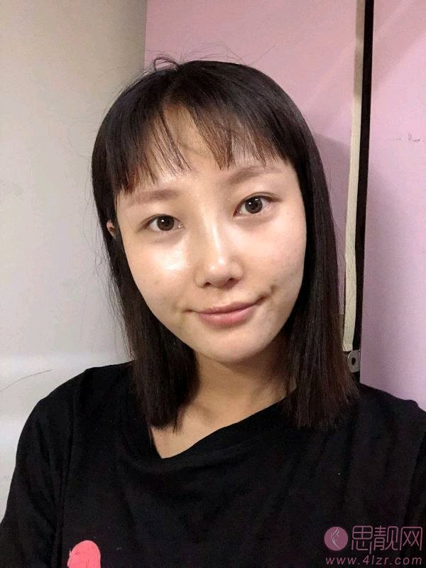 武汉希斯特杨权明做鼻子怎么样，附鼻子案例及价格表